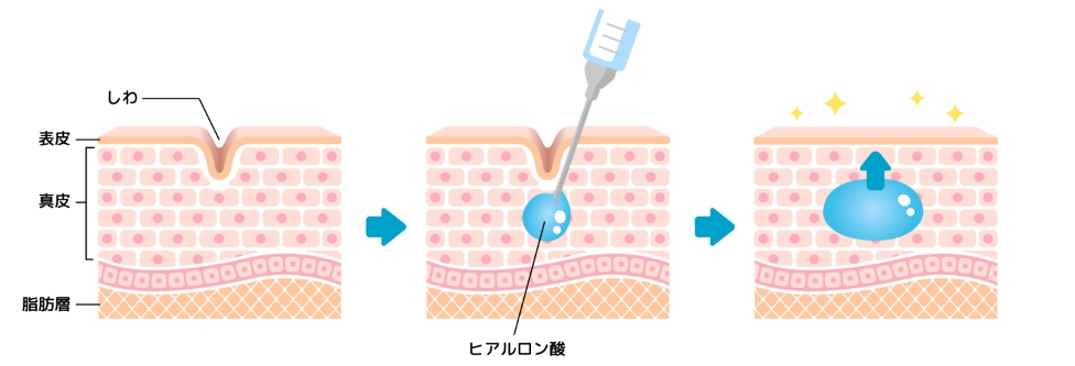 ヒアルロン酸注射の仕組み